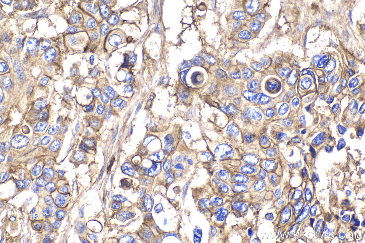 Immunohistochemical analysis of paraffin-embedded human stomach cancer tissue slide using KHC2158 (CYBB/NOX2 IHC Kit).