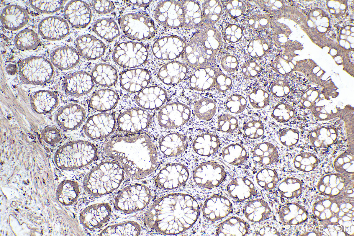 Immunohistochemical analysis of paraffin-embedded human rectal cancer tissue slide using KHC2505 (CYP1B1 IHC Kit).