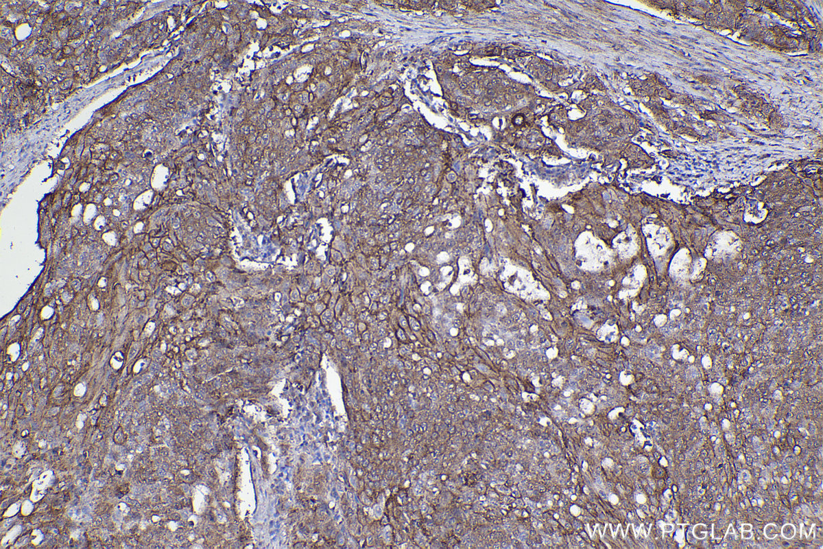 Immunohistochemical analysis of paraffin-embedded human cervical cancer tissue slide using KHC2513 (Cleaved Caspase 3 IHC Kit).