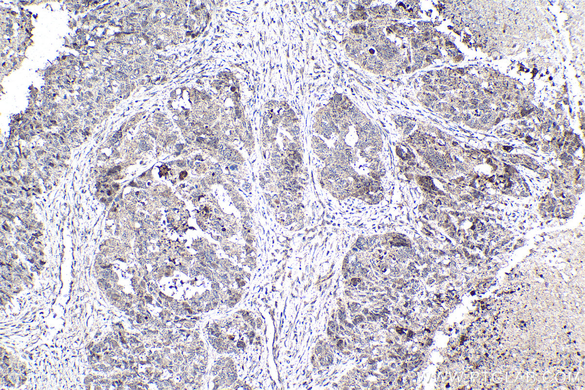 Immunohistochemical analysis of paraffin-embedded human ovary cancer tissue slide using KHC2513 (Cleaved Caspase 3 IHC Kit).