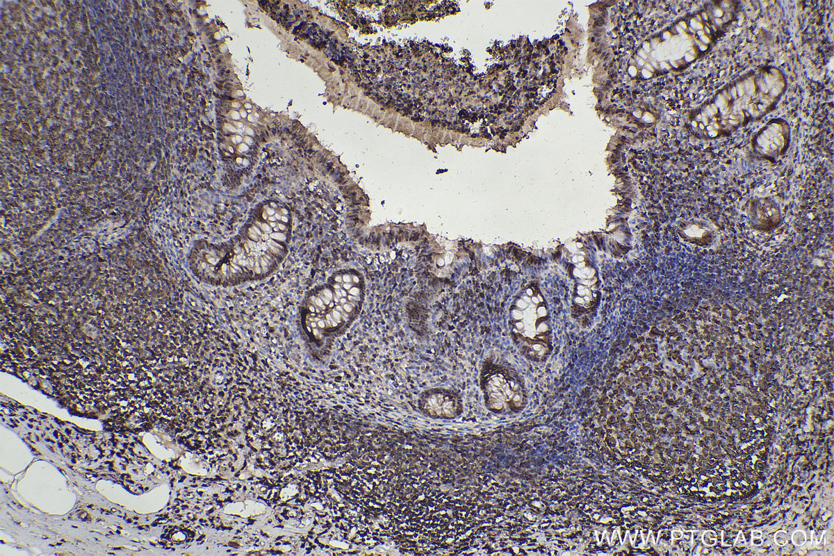 Immunohistochemical analysis of paraffin-embedded human appendicitis tissue slide using KHC2214 (DCK IHC Kit).