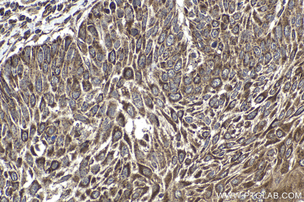 Immunohistochemical analysis of paraffin-embedded human oesophagus cancer tissue slide using KHC1424 (DDX3 IHC Kit).