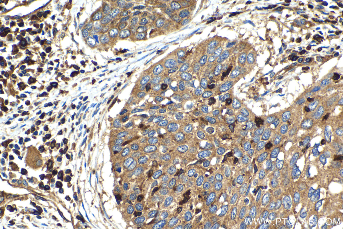 Immunohistochemical analysis of paraffin-embedded human oesophagus cancer tissue slide using KHC2100 (DIAPH1 IHC Kit).