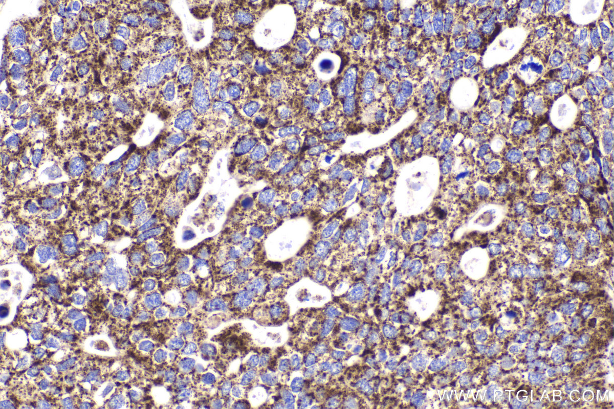 Immunohistochemical analysis of paraffin-embedded human ovary tumor tissue slide using KHC2174 (DLAT IHC Kit).