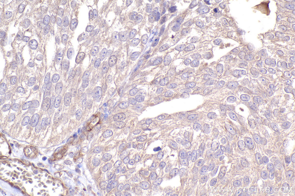 Immunohistochemical analysis of paraffin-embedded human ovary cancer tissue slide using KHC2454 (DOCK1 IHC Kit).