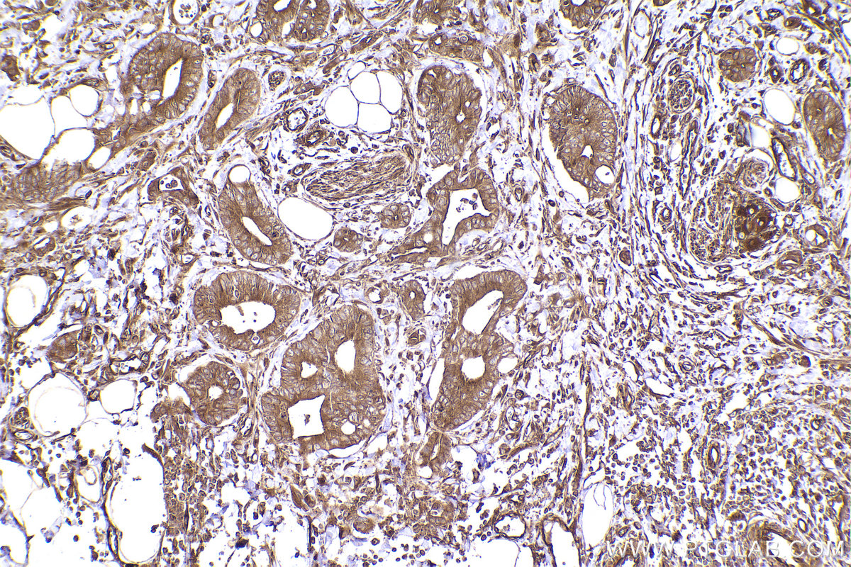 Immunohistochemical analysis of paraffin-embedded human rectal cancer tissue slide using KHC2455 (DYNC1H1 IHC Kit).