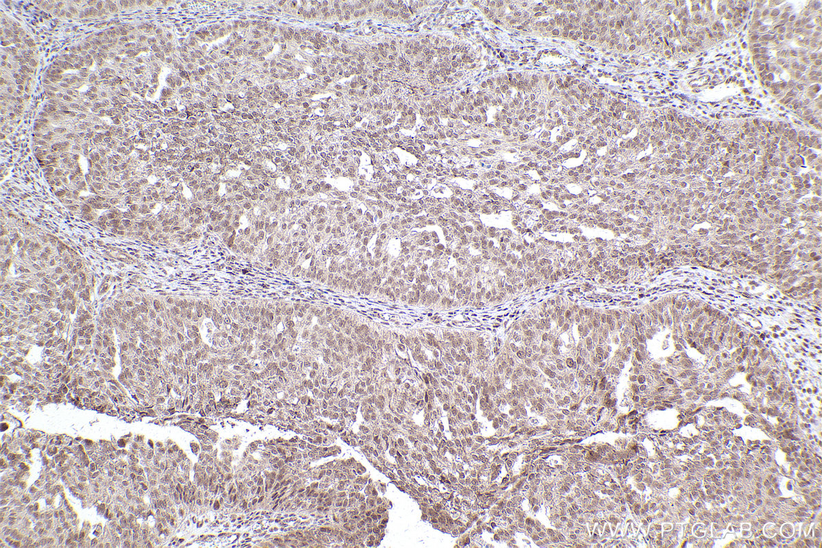 Immunohistochemical analysis of paraffin-embedded human ovary cancer tissue slide using KHC2539 (EAPP IHC Kit).