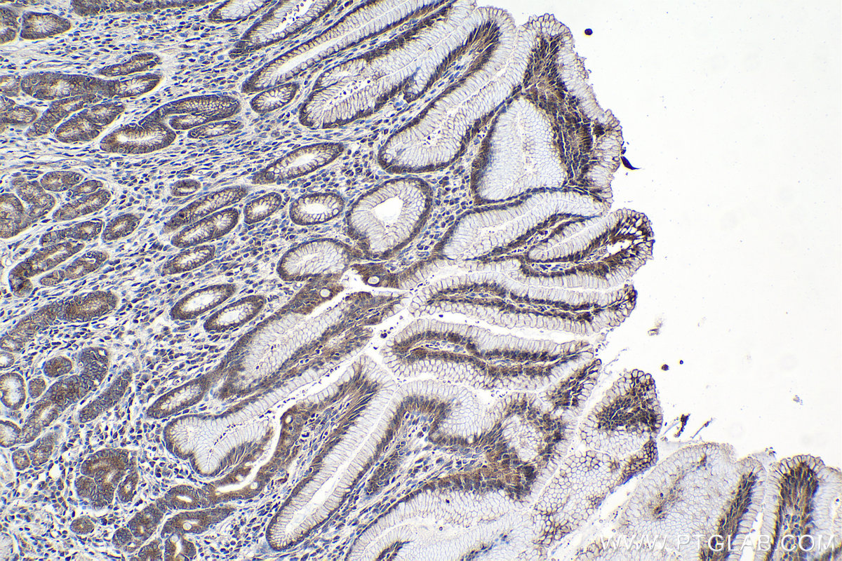 Immunohistochemical analysis of paraffin-embedded human stomach cancer tissue slide using KHC0996 (EDC4 IHC Kit).