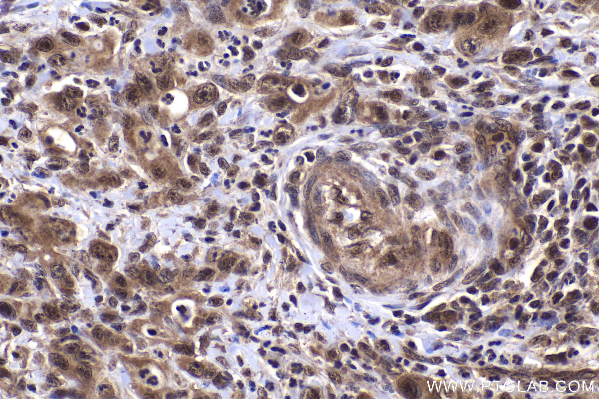 Immunohistochemical analysis of paraffin-embedded human stomach cancer tissue slide using KHC2032 (EID1 IHC Kit).