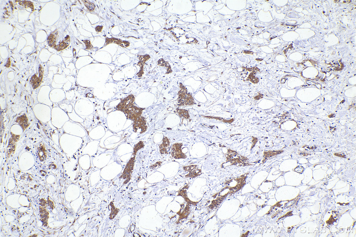 Immunohistochemical analysis of paraffin-embedded human urothelial carcinoma tissue slide using KHC2418 (EIF2B5 IHC Kit).