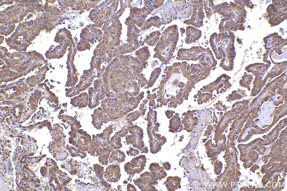 Immunohistochemical analysis of paraffin-embedded human thyroid cancer tissue slide using KHC2327 (EIF5 IHC Kit).