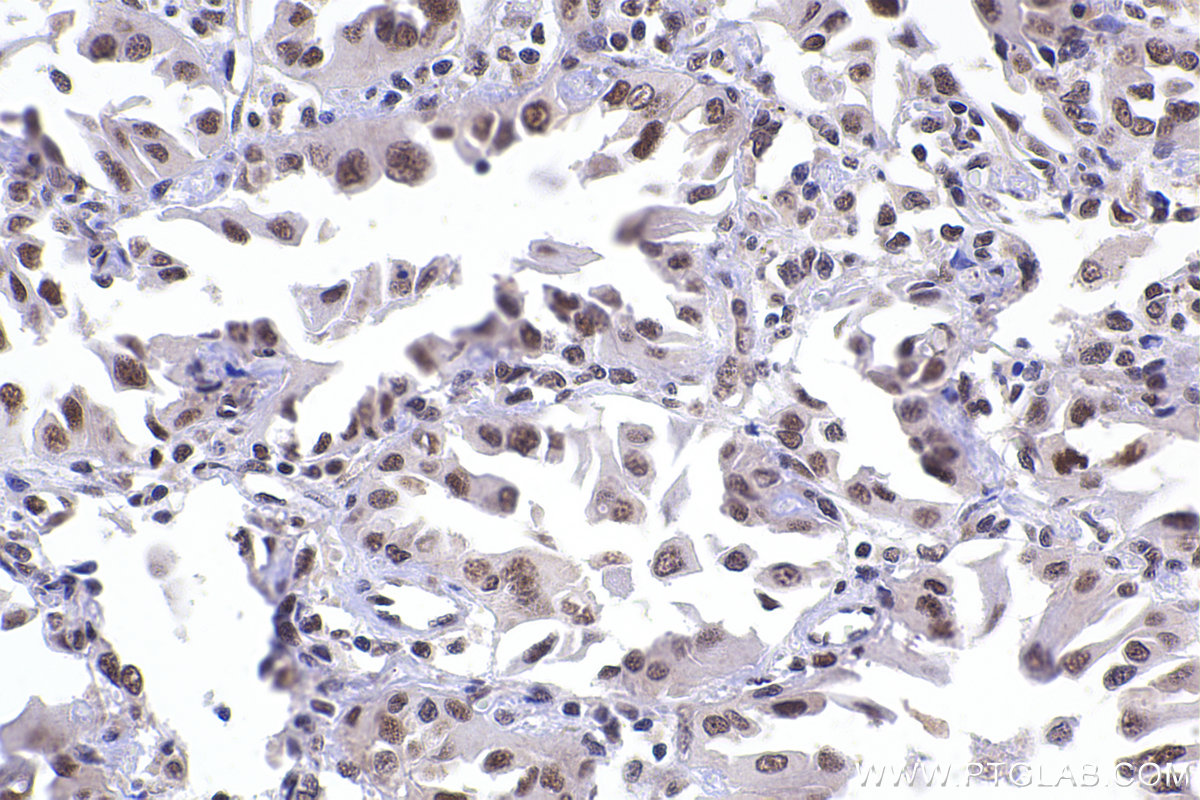 Immunohistochemical analysis of paraffin-embedded human lung cancer tissue slide using KHC2373 (ERH IHC Kit).