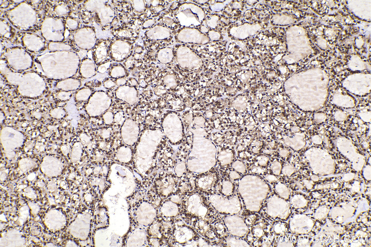 Immunohistochemical analysis of paraffin-embedded human thyroid cancer tissue slide using KHC2151 (FAM107A IHC Kit).