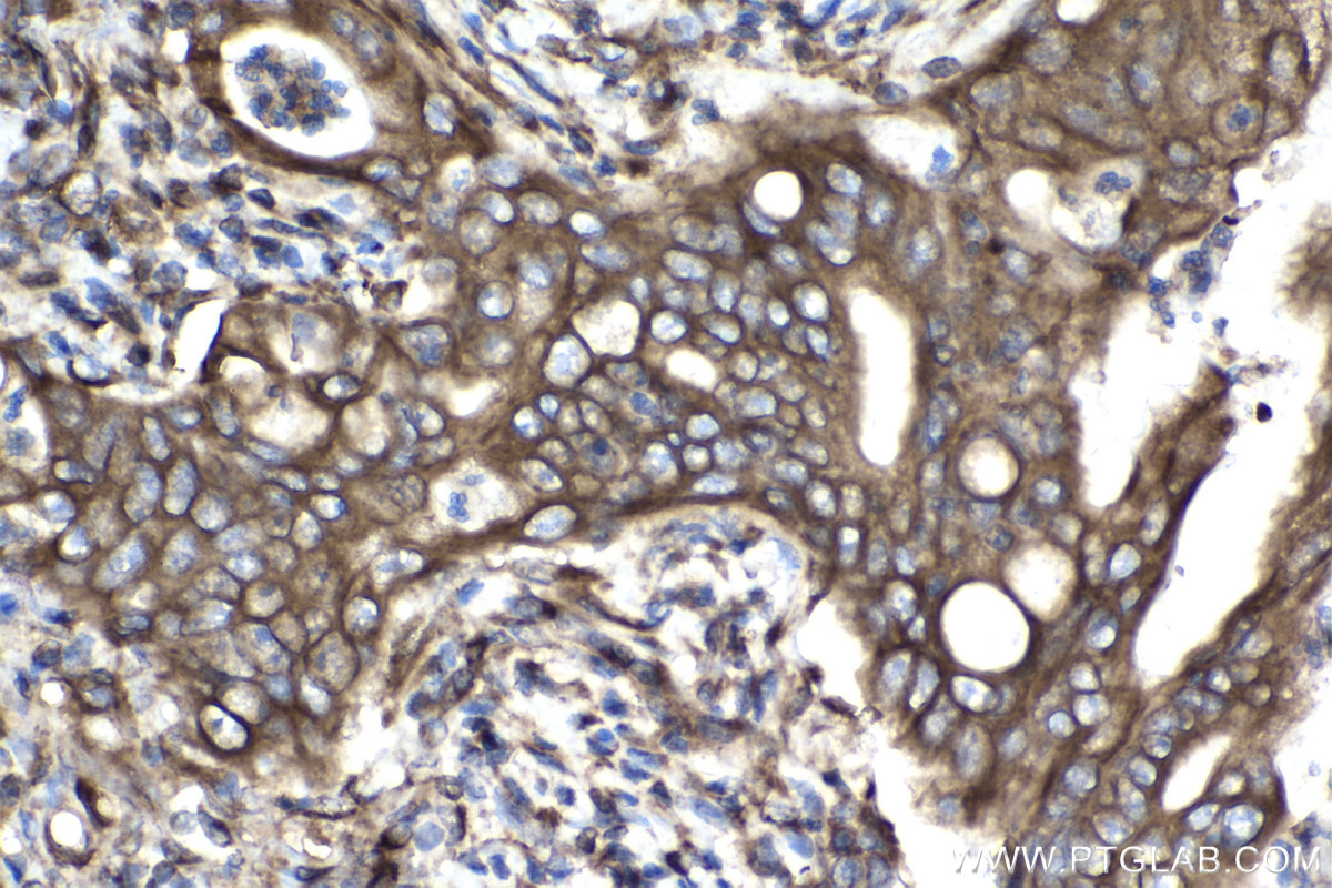 Immunohistochemical analysis of paraffin-embedded human stomach cancer tissue slide using KHC2082 (FAM62B IHC Kit).