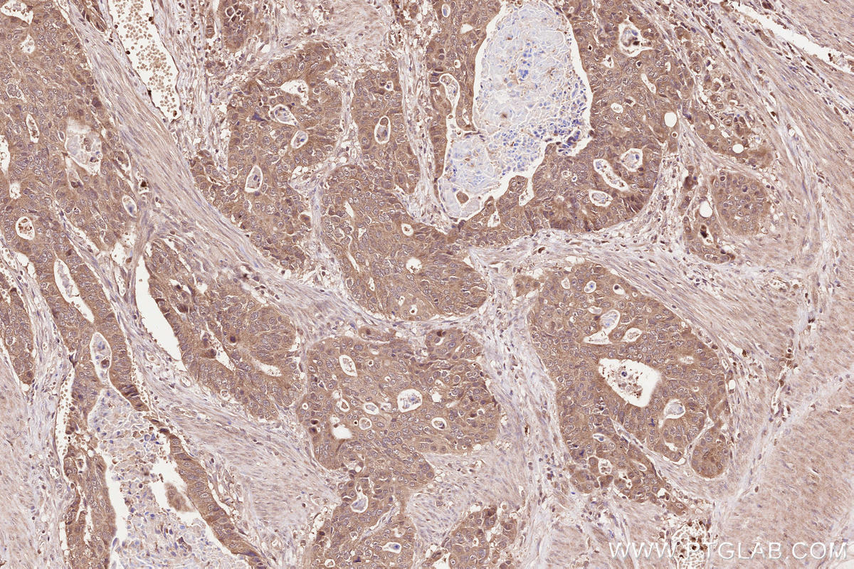 Immunohistochemical analysis of paraffin-embedded human stomach cancer tissue slide using KHC2548 (FAM83B IHC Kit).