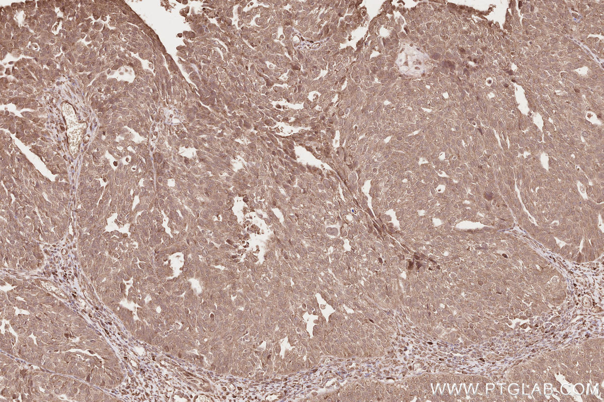 Immunohistochemical analysis of paraffin-embedded human ovary cancer tissue slide using KHC2567 (FBXO31 IHC Kit).