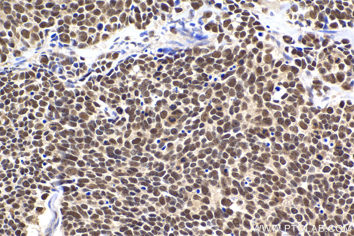 Immunohistochemical analysis of paraffin-embedded human lung cancer tissue slide using KHC2256 (FEN1 IHC Kit).