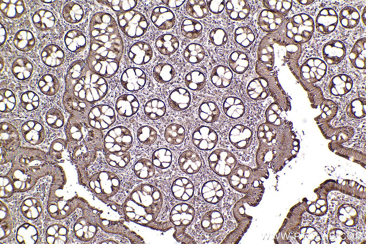 Immunohistochemical analysis of paraffin-embedded human rectal cancer tissue slide using KHC2456 (FLOT2/Flotillin 2 IHC Kit).