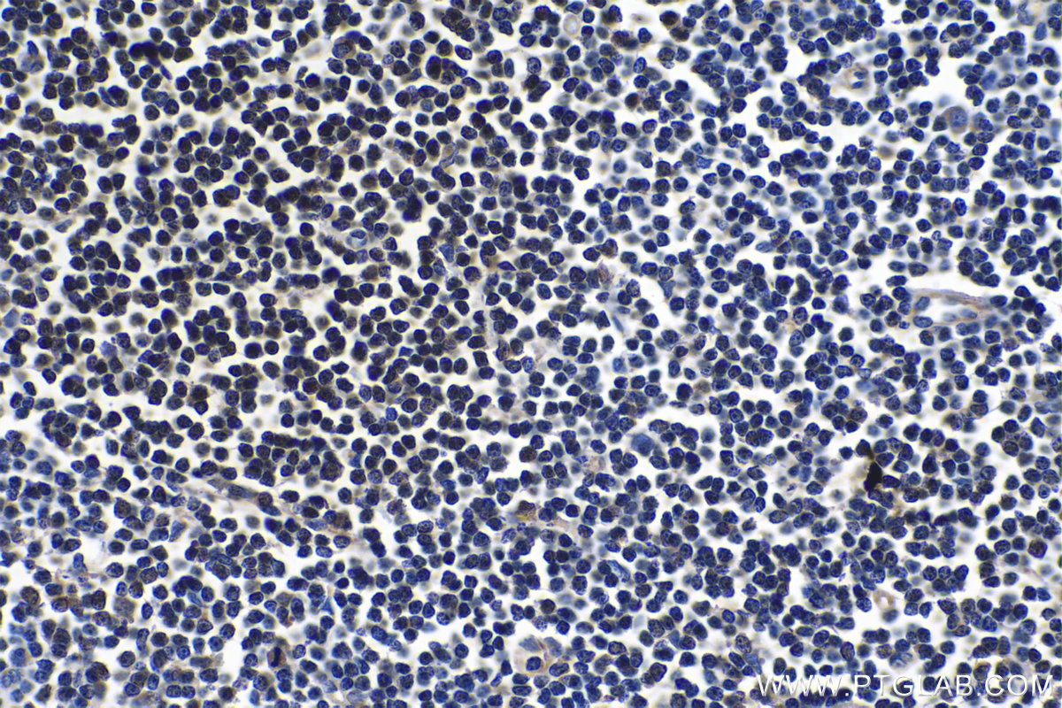 Immunohistochemical analysis of paraffin-embedded human lymphoma tissue slide using KHC1063 (FOXP1 IHC Kit).