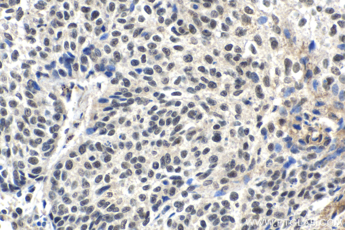 Immunohistochemical analysis of paraffin-embedded human lung cancer tissue slide using KHC1498 (FSTL3 IHC Kit).