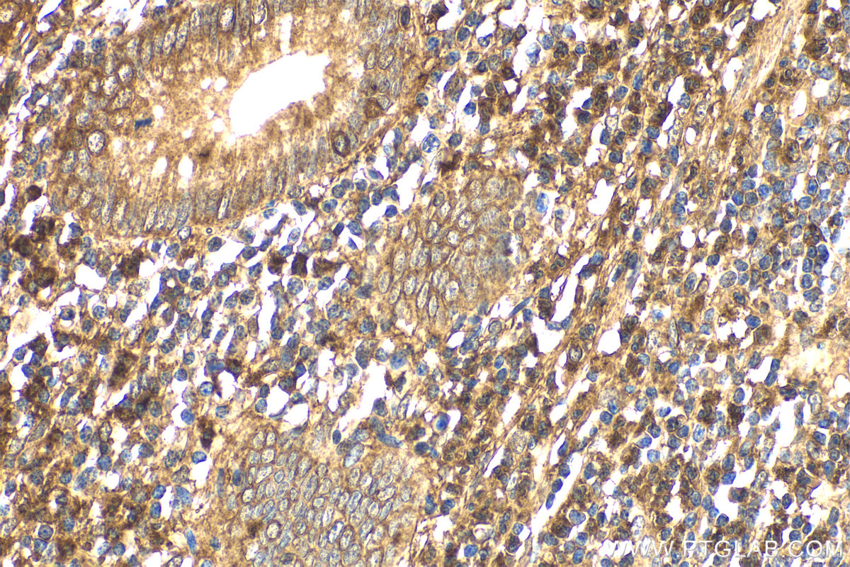 Immunohistochemical analysis of paraffin-embedded human appendicitis tissue slide using KHC2164 (FYN IHC Kit).