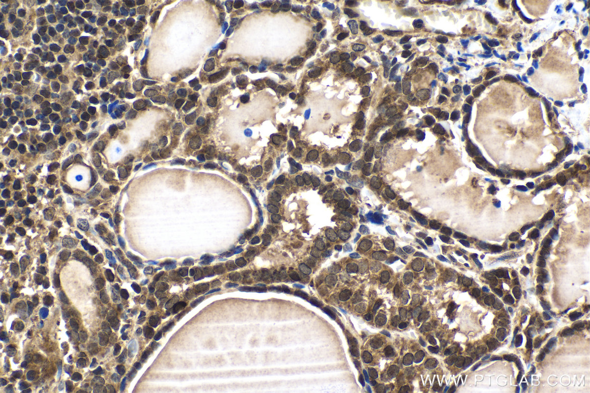 Immunohistochemical analysis of paraffin-embedded human thyroid cancer tissue slide using KHC1464 (GANP IHC Kit).