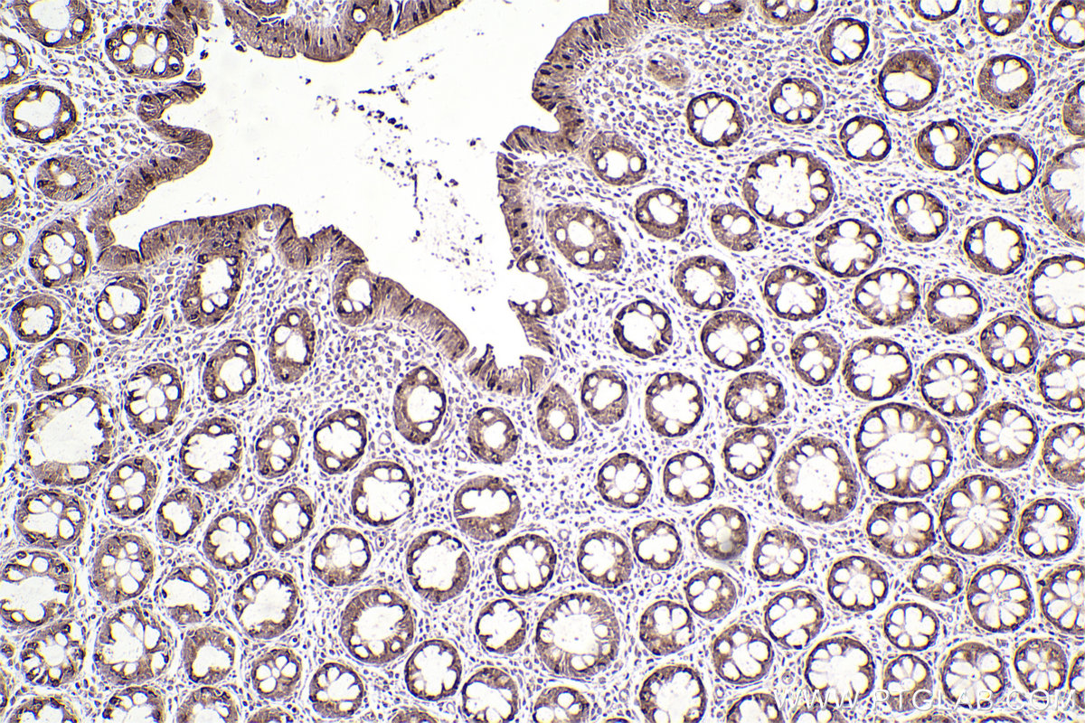 Immunohistochemical analysis of paraffin-embedded human rectal cancer tissue slide using KHC2552 (GJC2 IHC Kit).