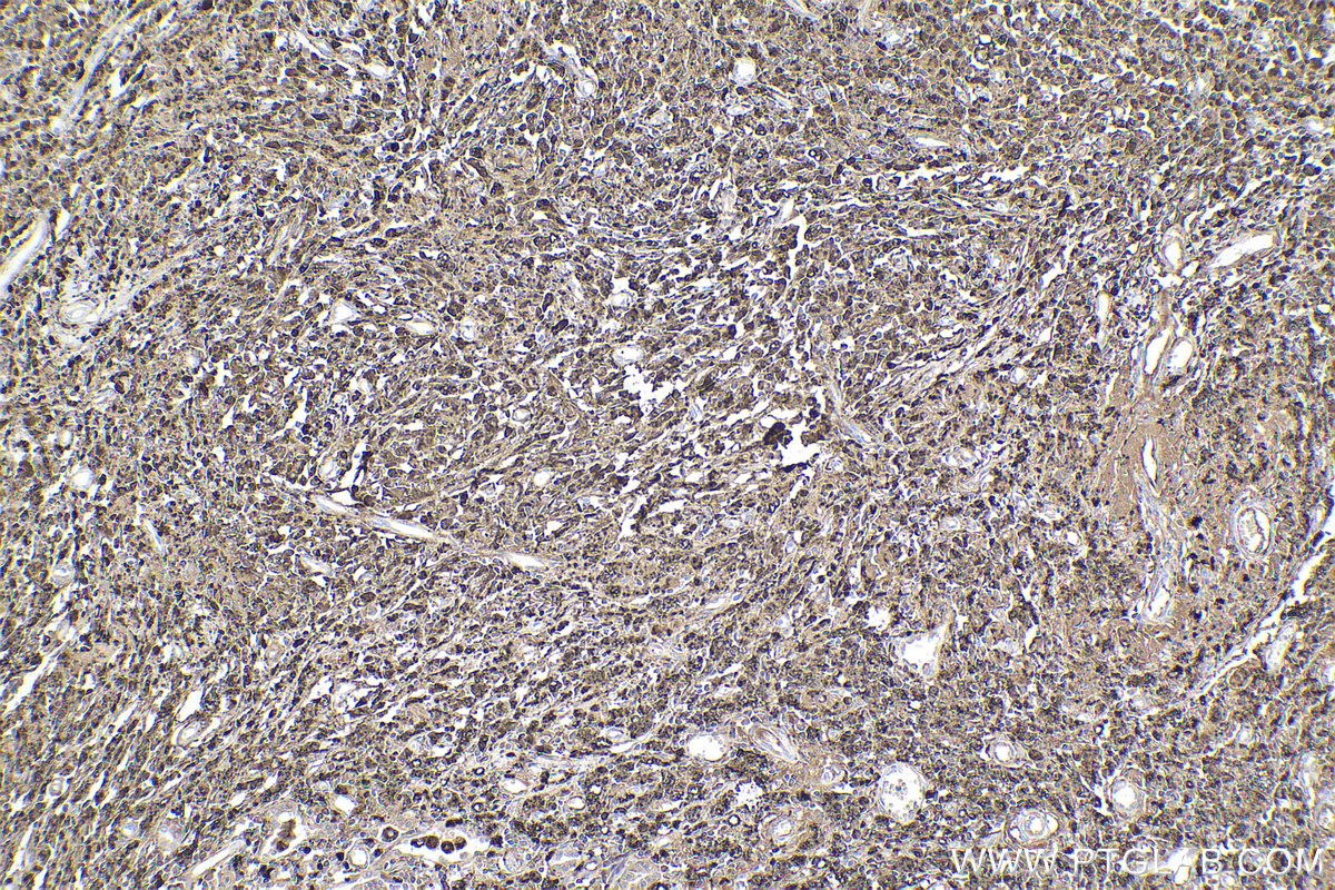 Immunohistochemical analysis of paraffin-embedded human lung cancer tissue slide using KHC2516 (GPNMB IHC Kit).