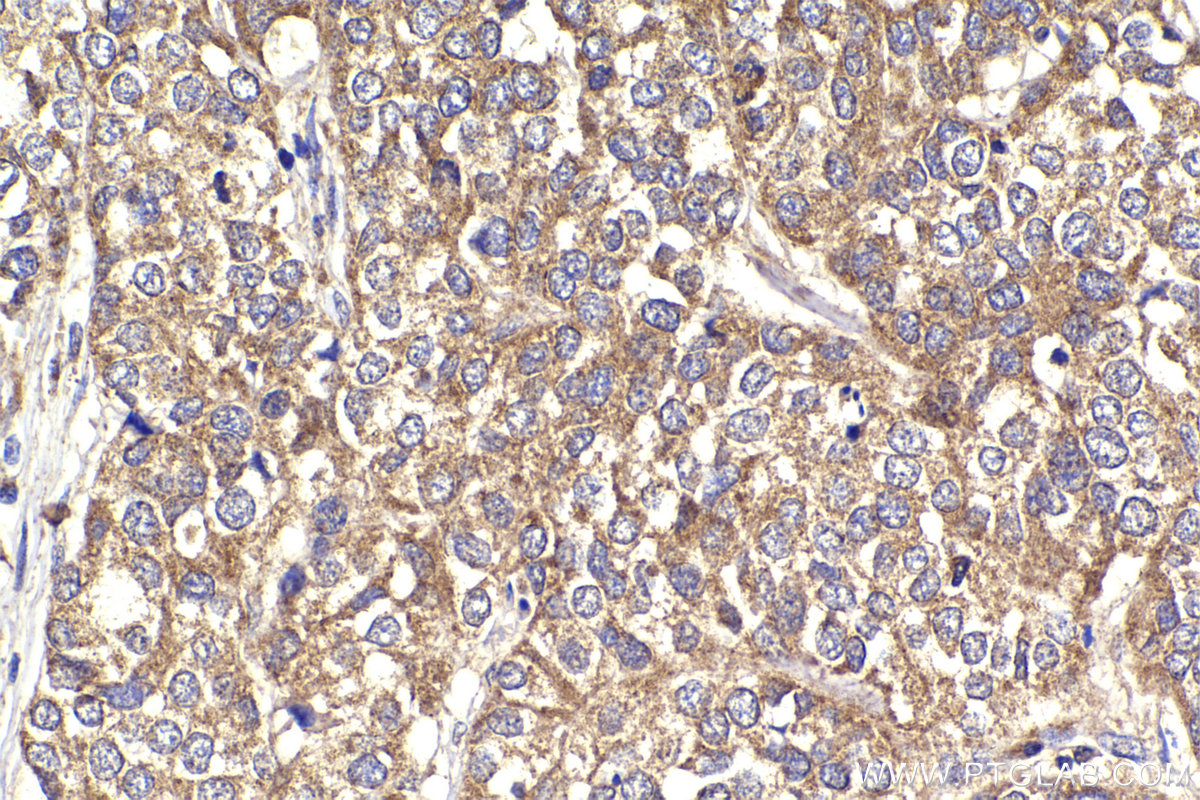 Immunohistochemical analysis of paraffin-embedded human stomach cancer tissue slide using KHC2292 (GSK3A IHC Kit).