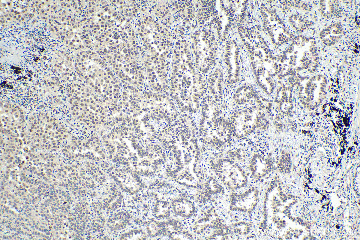Immunohistochemical analysis of paraffin-embedded human lung cancer tissue slide using KHC1579 (GTF2H1 IHC Kit).