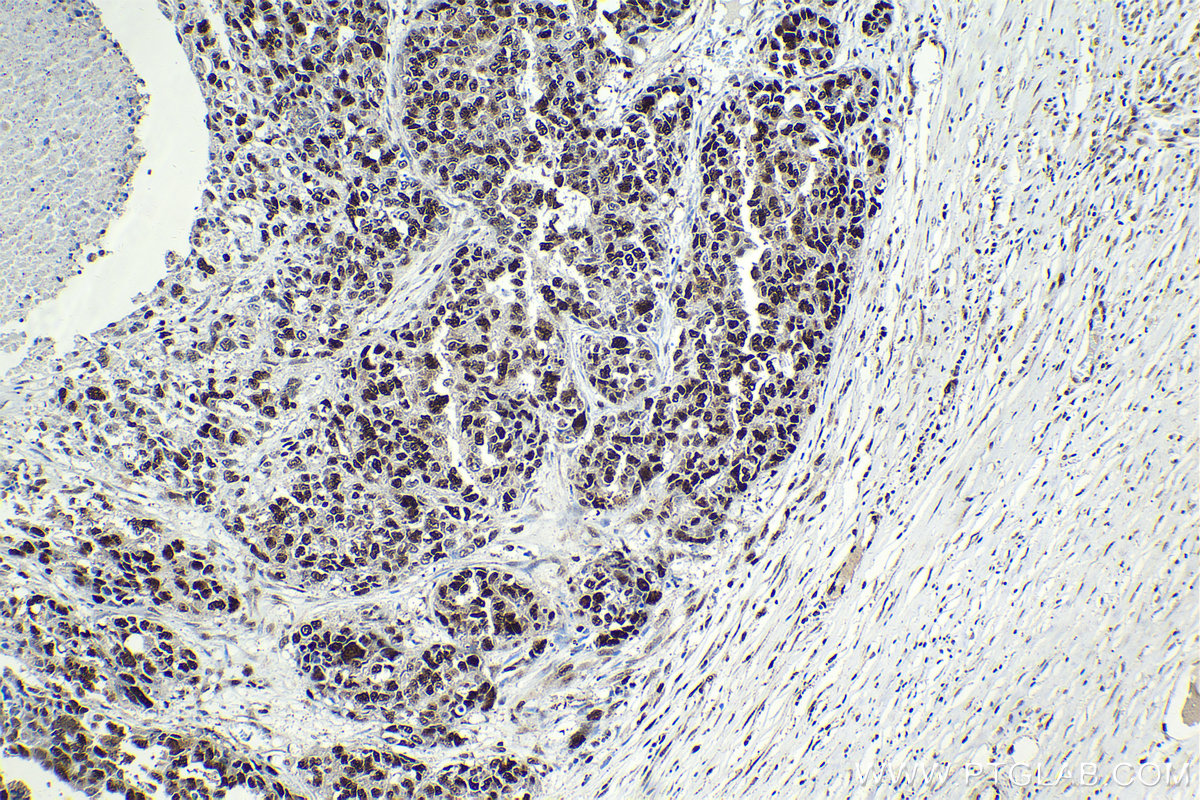 Immunohistochemical analysis of paraffin-embedded human ovary cancer tissue slide using KHC2062 (HAT1 IHC Kit).