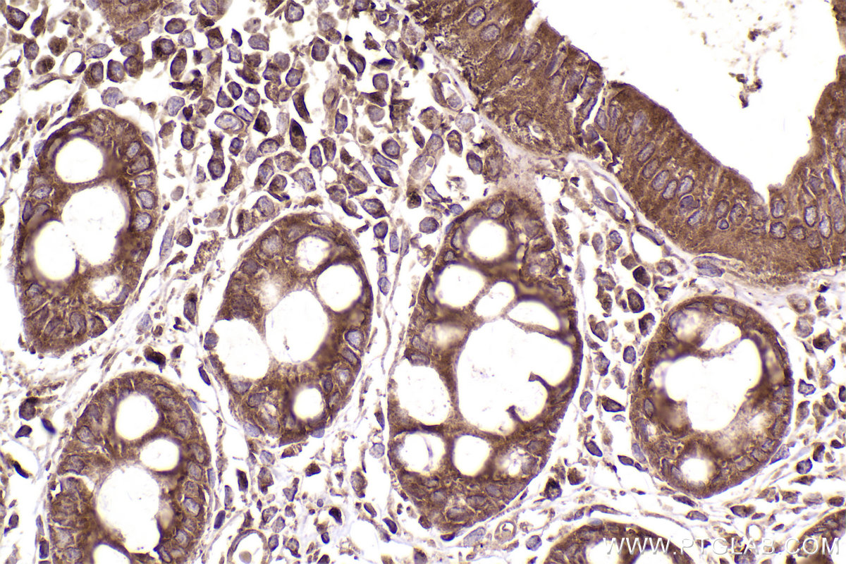 Immunohistochemical analysis of paraffin-embedded human rectal cancer tissue slide using KHC2553 (HECTD3 IHC Kit).