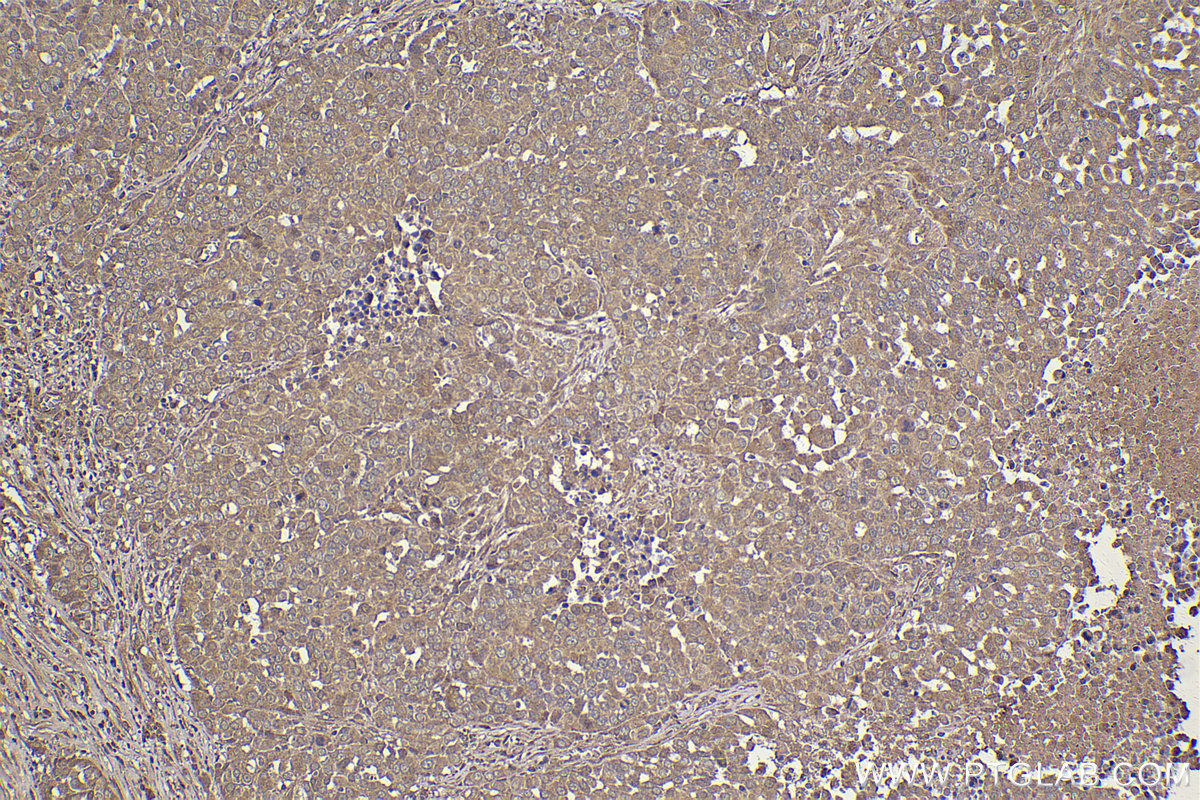 Immunohistochemical analysis of paraffin-embedded human ovary tumor tissue slide using KHC2190 (HPGD IHC Kit).