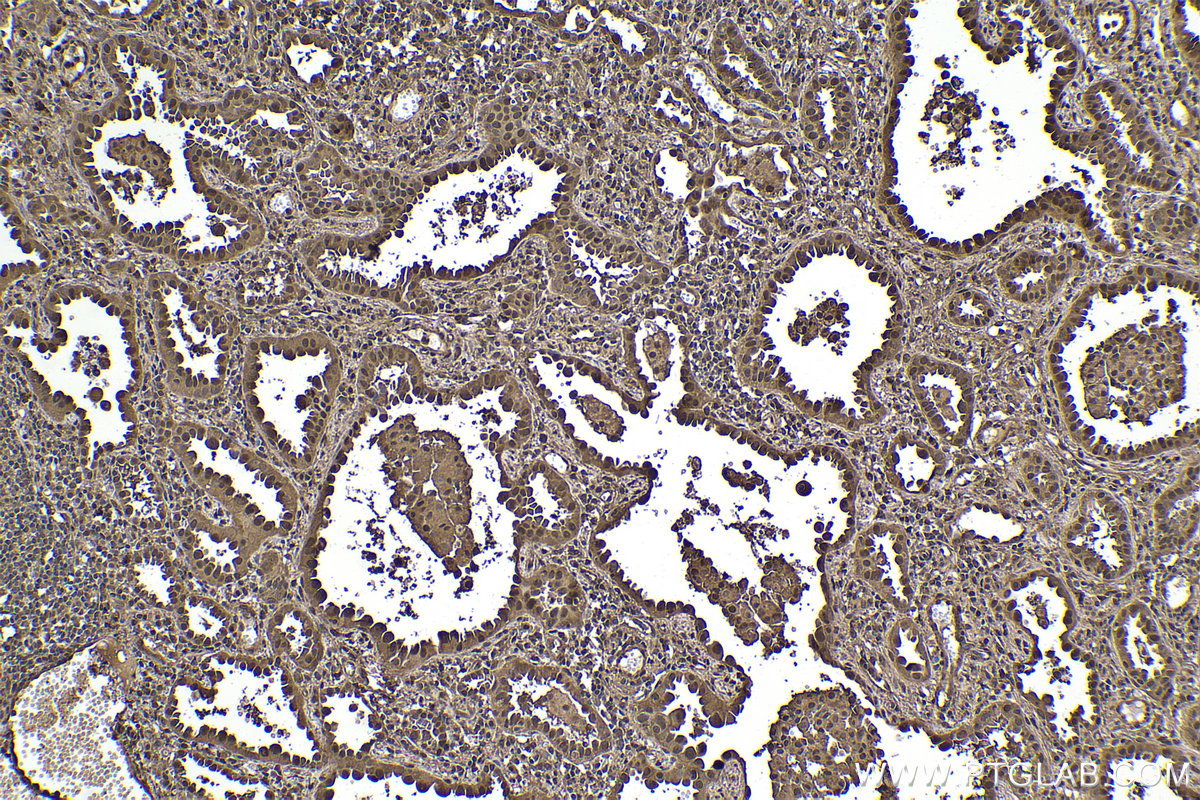 Immunohistochemical analysis of paraffin-embedded human lung cancer tissue slide using KHC2243 (HSPA1L IHC Kit).