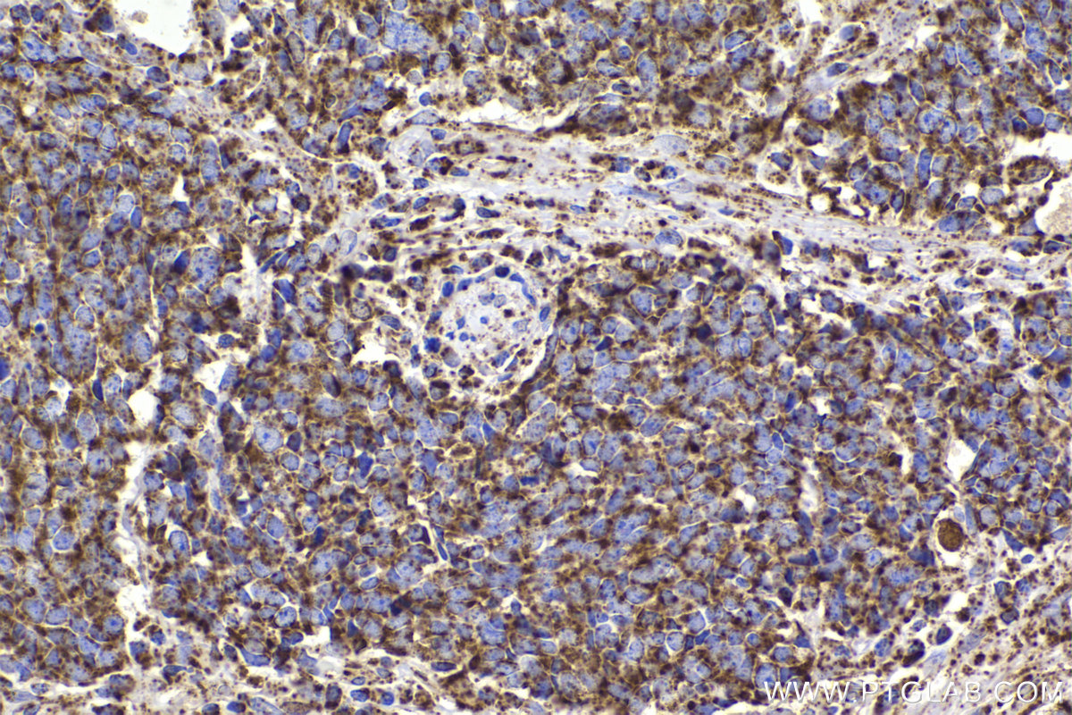 Immunohistochemical analysis of paraffin-embedded human lung cancer tissue slide using KHC2340 (HSPE1 IHC Kit).