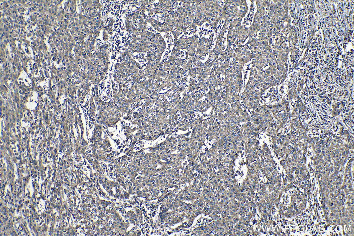 Immunohistochemical analysis of paraffin-embedded human cervical cancer tissue slide using KHC1238 (IARS2 IHC Kit).