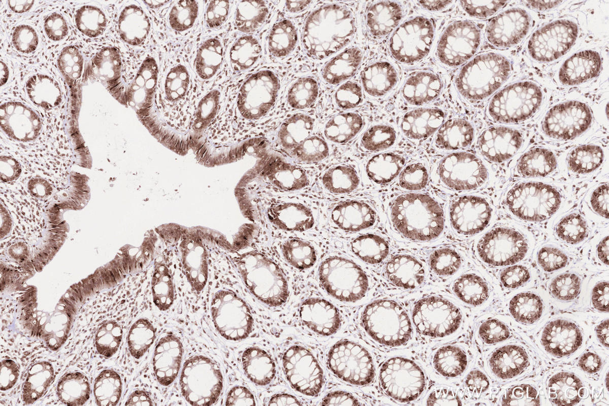 Immunohistochemical analysis of paraffin-embedded human rectal cancer tissue slide using KHC2586 (INTS5 IHC Kit).