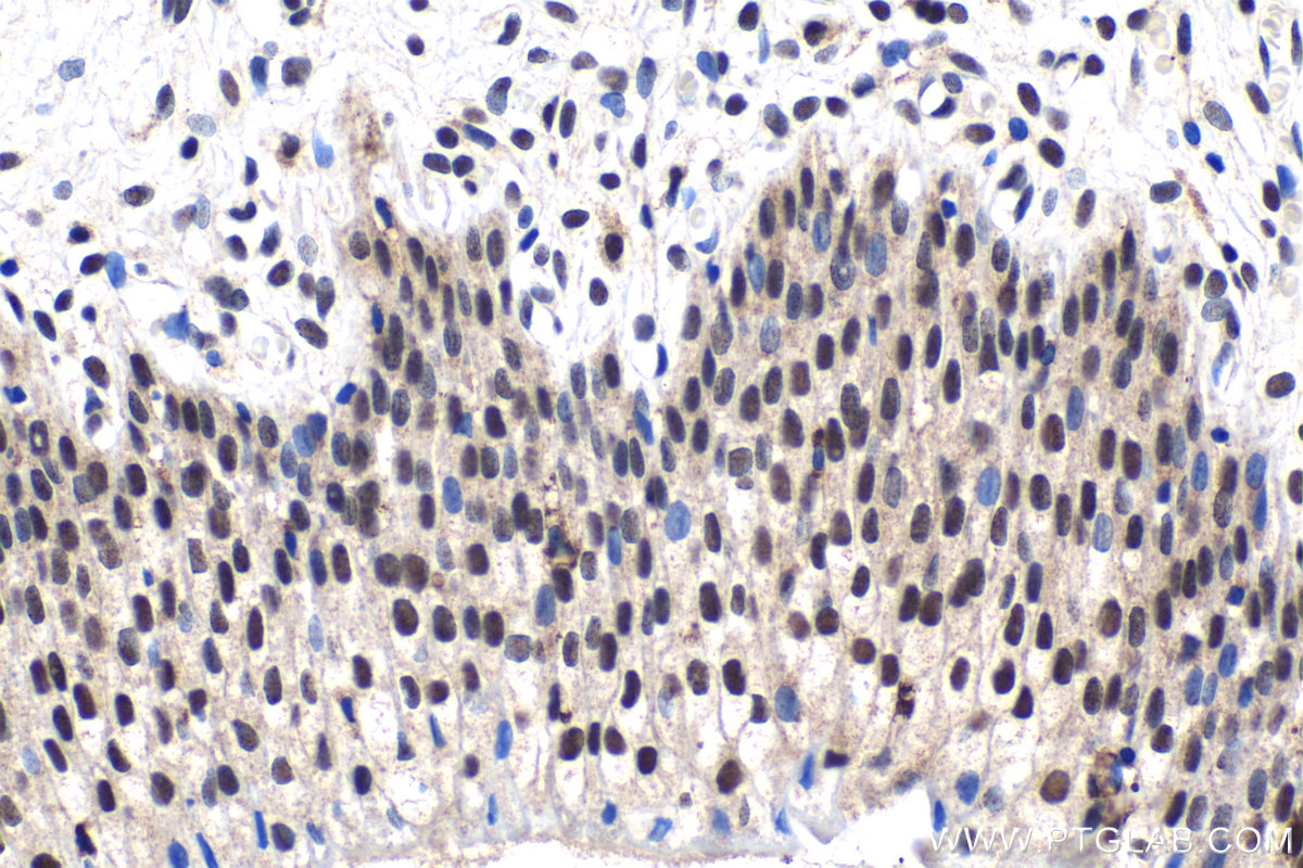 Immunohistochemical analysis of paraffin-embedded human urothelial carcinoma tissue slide using KHC1531 (IRF2 IHC Kit).