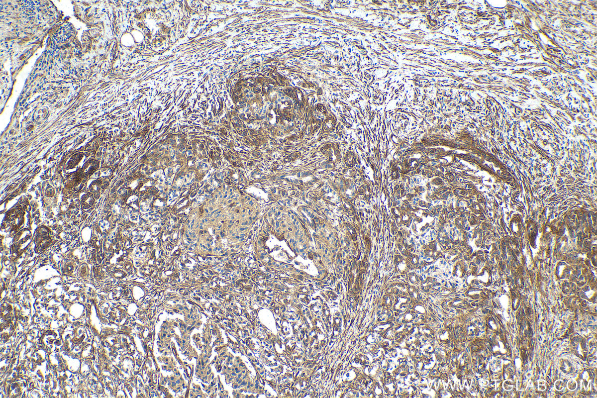 Immunohistochemical analysis of paraffin-embedded human pancreas cancer tissue slide using KHC2163 (ITGB1/CD29 IHC Kit).