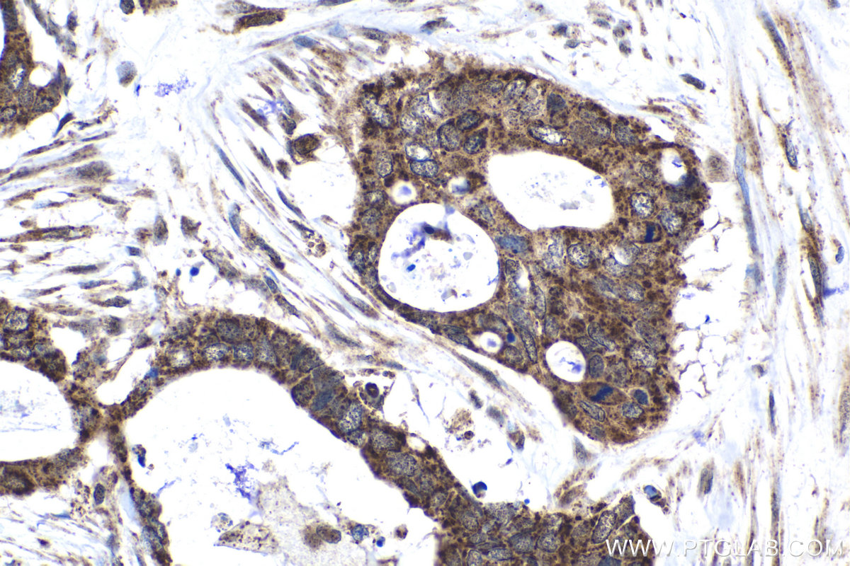 Immunohistochemical analysis of paraffin-embedded human urothelial carcinoma tissue slide using KHC1517 (JMJD7 IHC Kit).