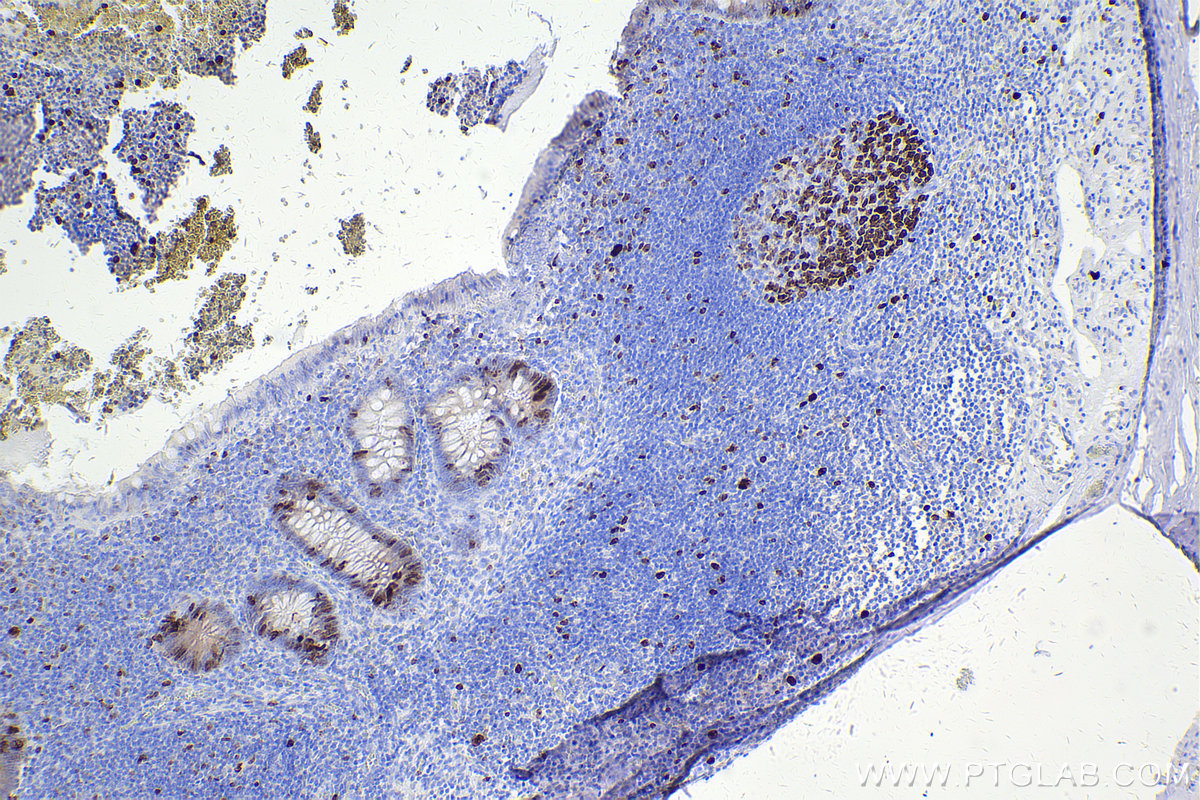 Immunohistochemical analysis of paraffin-embedded human appendicitis tissue slide using KHC2461 (KI67 IHC Kit).