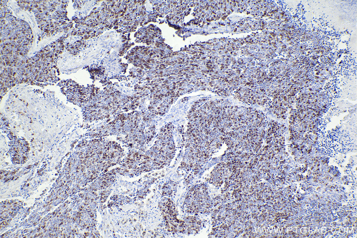 Immunohistochemical analysis of paraffin-embedded human lung cancer tissue slide using KHC2461 (KI67 IHC Kit).