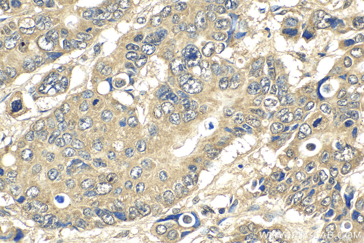 Immunohistochemical analysis of paraffin-embedded human stomach cancer tissue slide using KHC2137 (KIF20A IHC Kit).