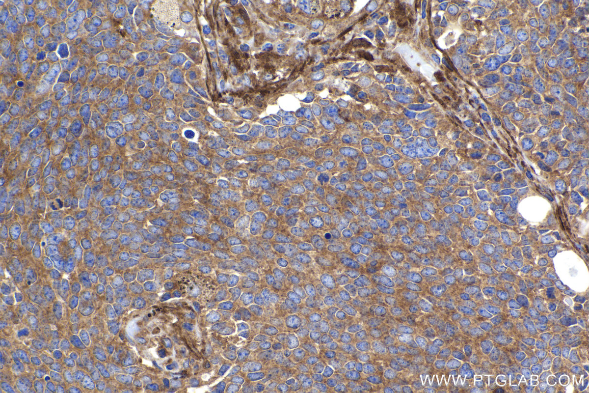 Immunohistochemical analysis of paraffin-embedded human lung cancer tissue slide using KHC2238 (KIF5B IHC Kit).