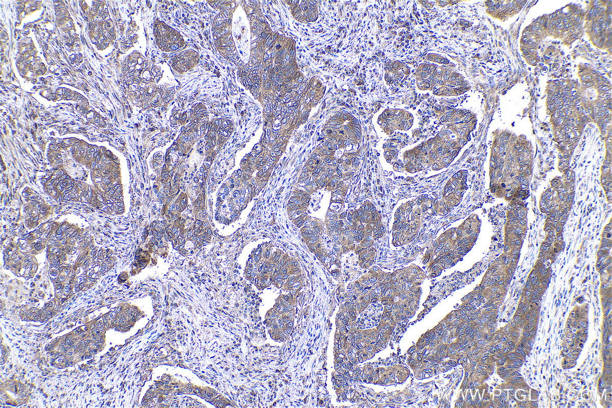Immunohistochemical analysis of paraffin-embedded human stomach cancer tissue slide using KHC0963 (KLC2 IHC Kit).