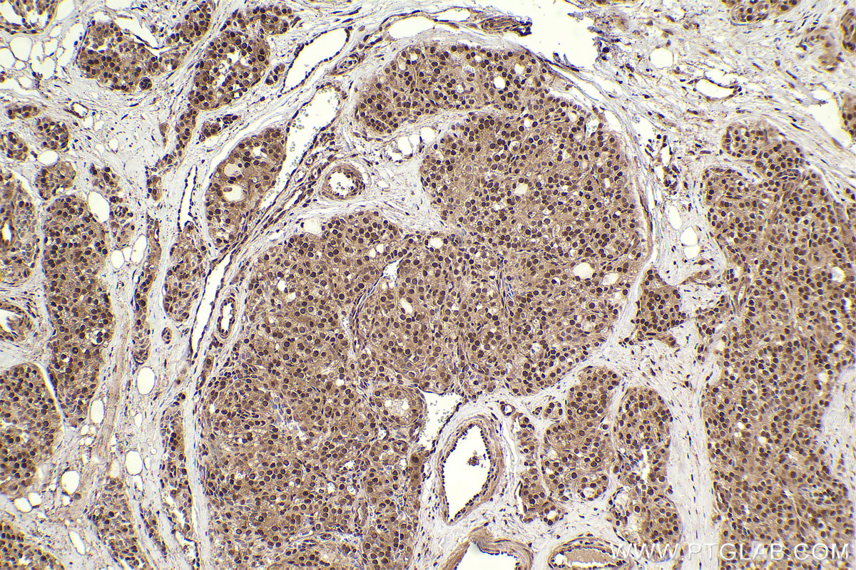 Immunohistochemical analysis of paraffin-embedded human thyroid cancer tissue slide using KHC2310 (KPNA1 IHC Kit).