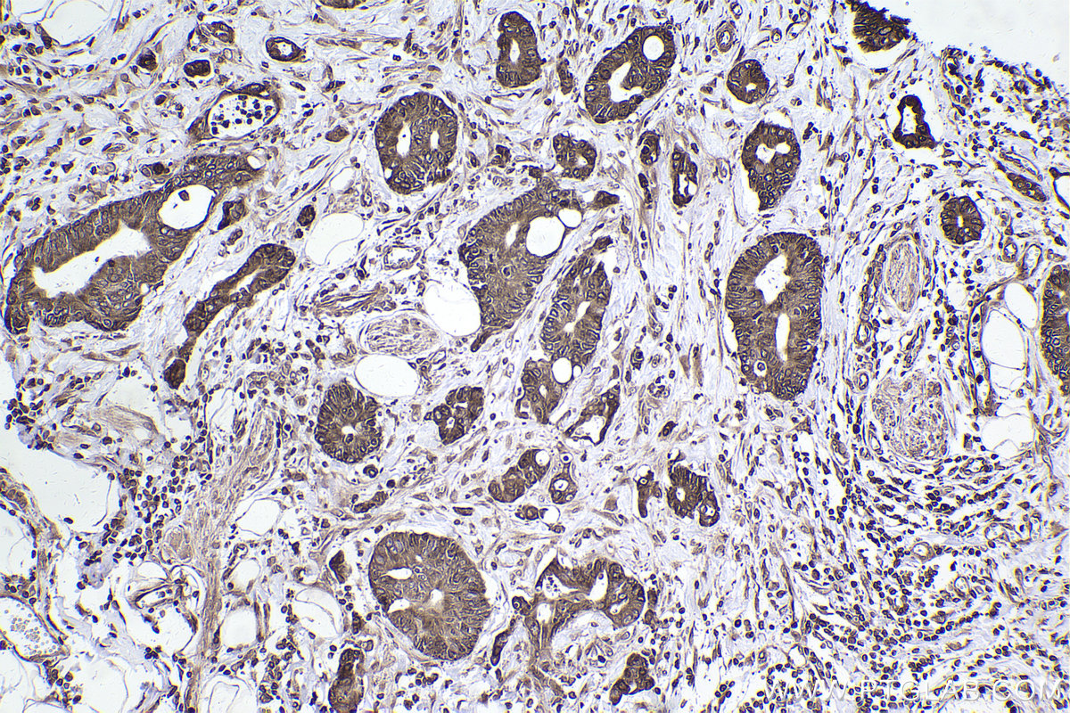 Immunohistochemical analysis of paraffin-embedded human rectal cancer tissue slide using KHC2467 (LBR IHC Kit).