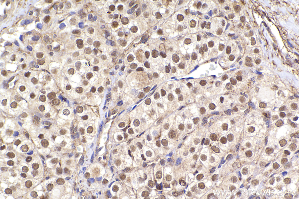 Immunohistochemical analysis of paraffin-embedded human thyroid cancer tissue slide using KHC2294 (LIG3 IHC Kit).