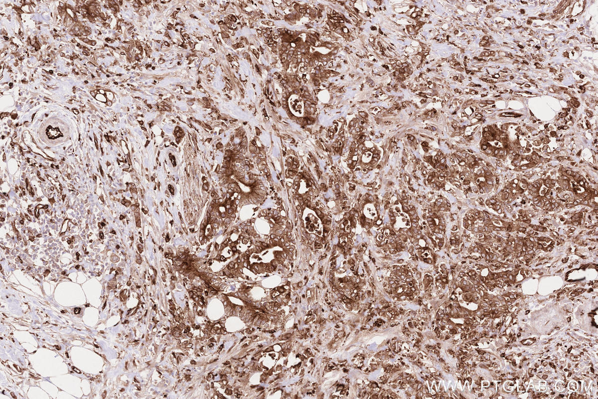 Immunohistochemical analysis of paraffin-embedded human rectal cancer tissue slide using KHC2615 (LPCAT2 IHC Kit).