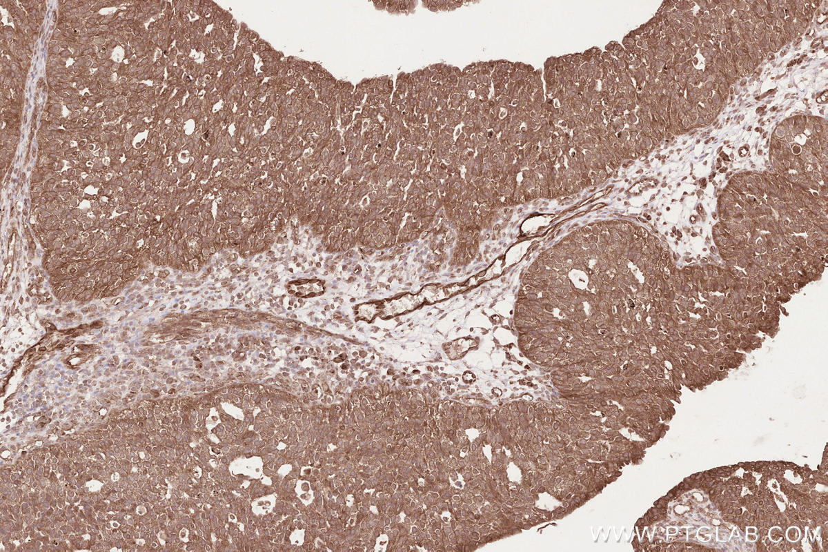 Immunohistochemical analysis of paraffin-embedded human ovary cancer tissue slide using KHC2570 (LPCAT4 IHC Kit).